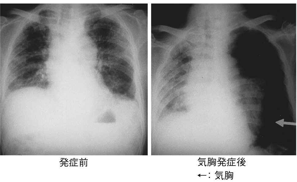気胸(肺の虚脱) - 健康百科事典