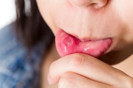 長引く口内炎は、口腔がんの可能性も…